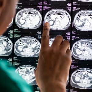 Beyond the Injury: Why Researchers Are Studying HBOT for Traumatic Brain InjuryWhy Oxygen Matters in Wound Healing