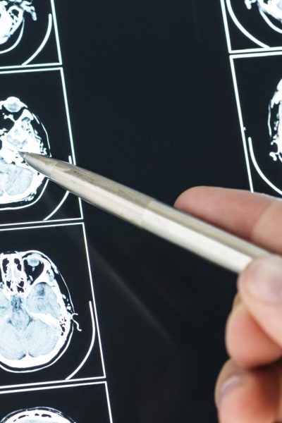 Closeup of brain MRI scan result
